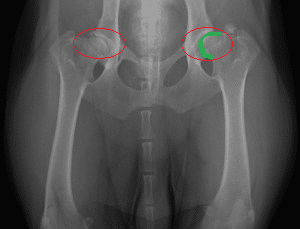 hip dysplasia